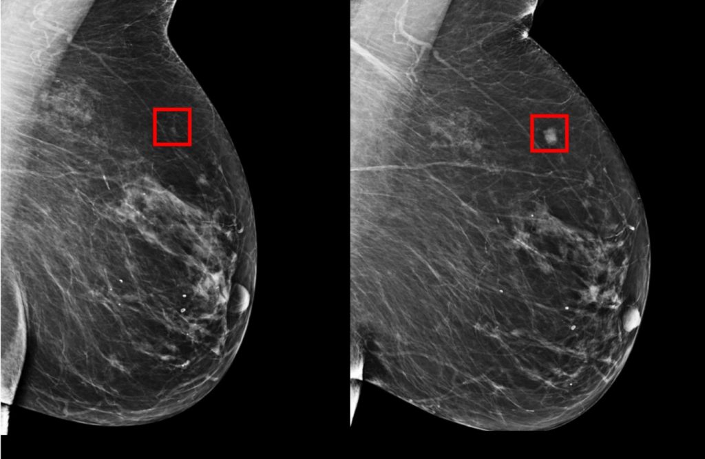 BreastCancerAI-min