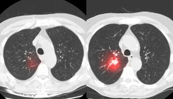 final_lungcancer3